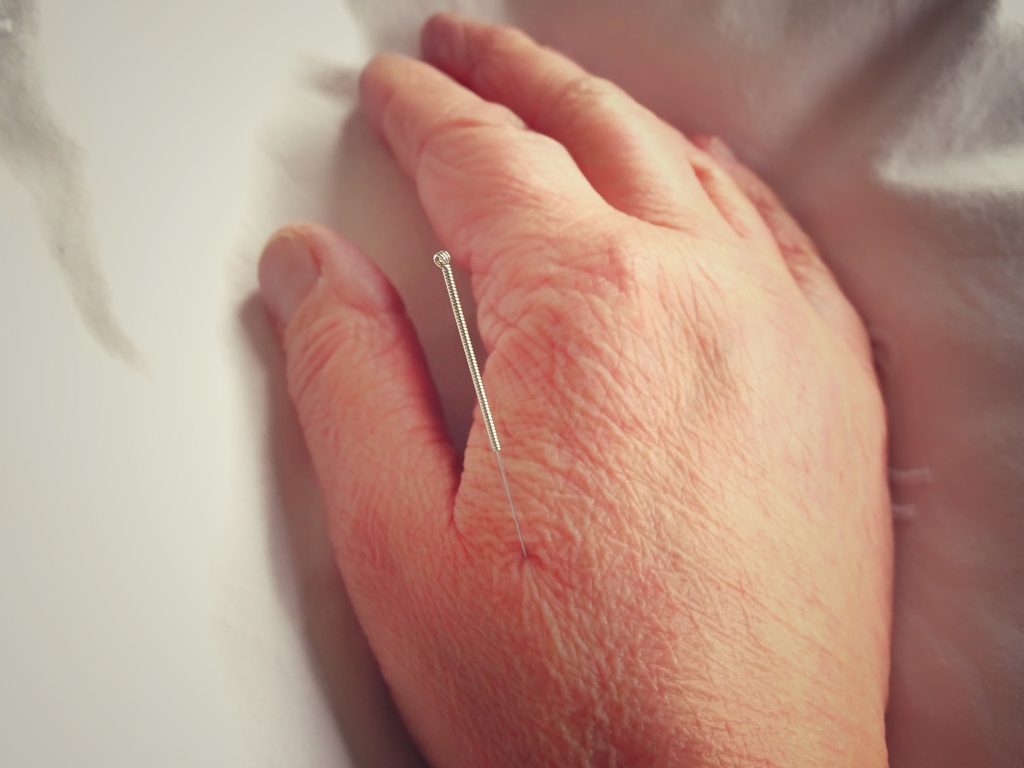 hand acupuncture needle hand