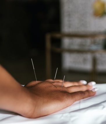 acupuncture hand